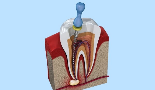 endodontia Ceilândia