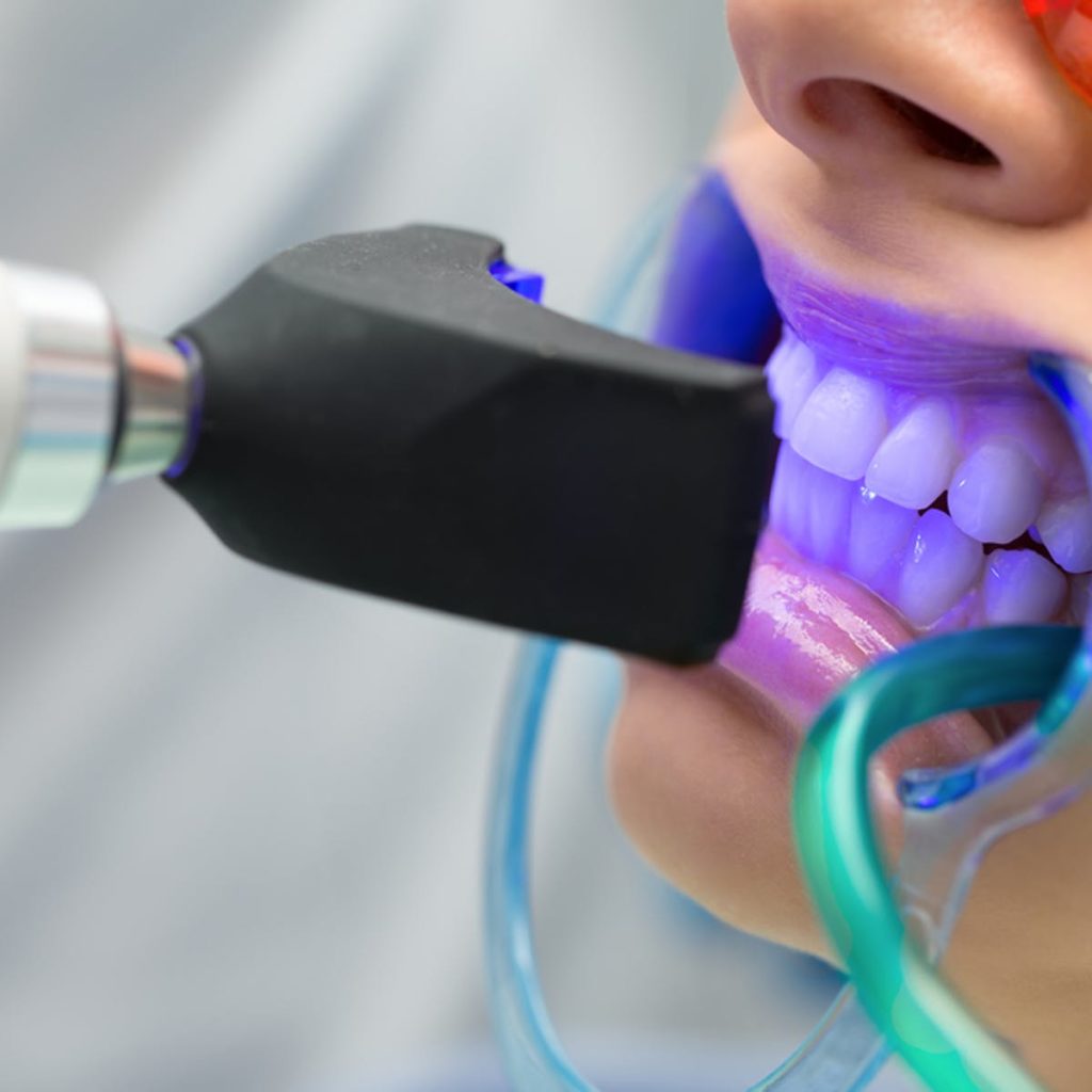 Clareamento dental INTERFACE ODONTOLOGIA
