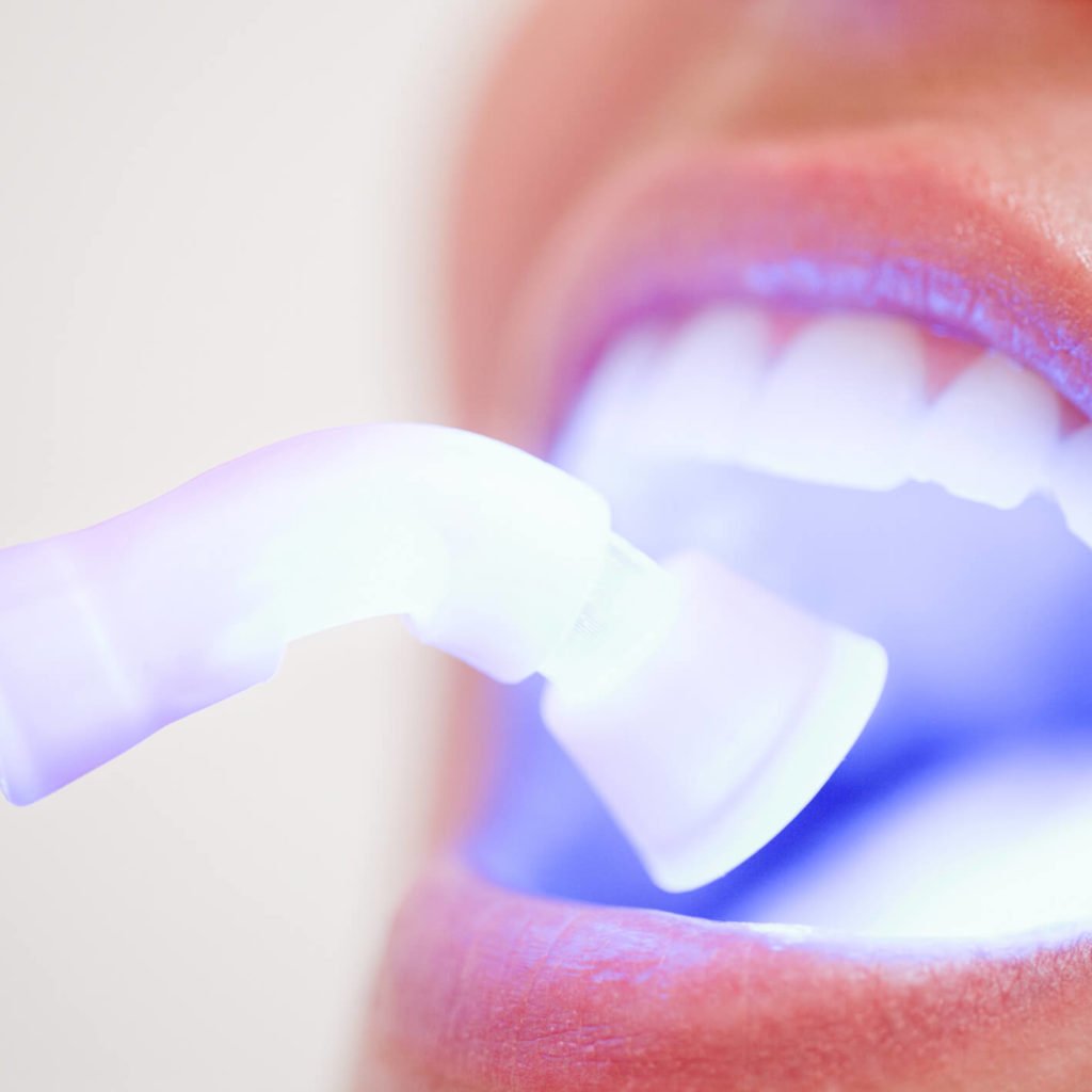 clareamento dental caseiro