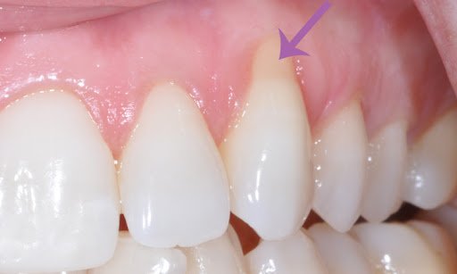 O que causa a doença periodontal?