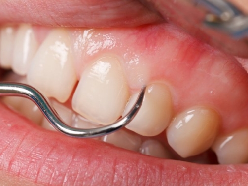 Quais os impactos das doenças periodontais (3)
