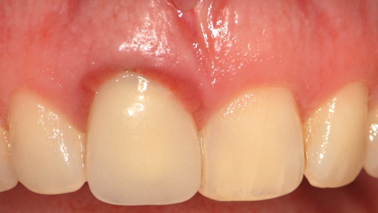 Quais os impactos das doenças periodontais