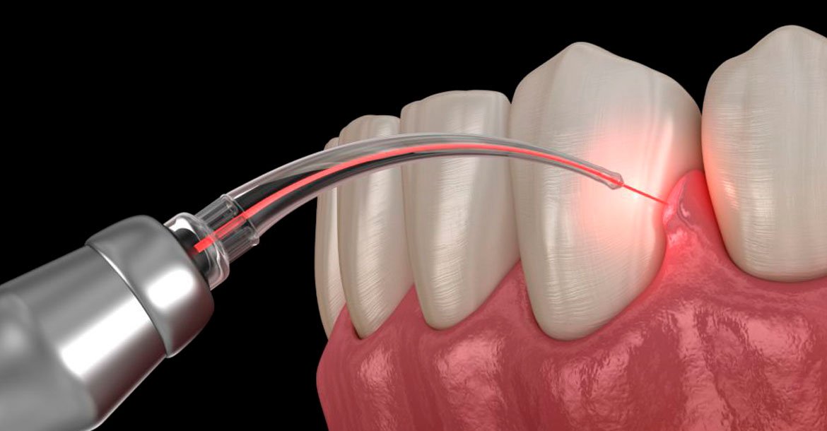 Quais os impactos das doenças periodontais