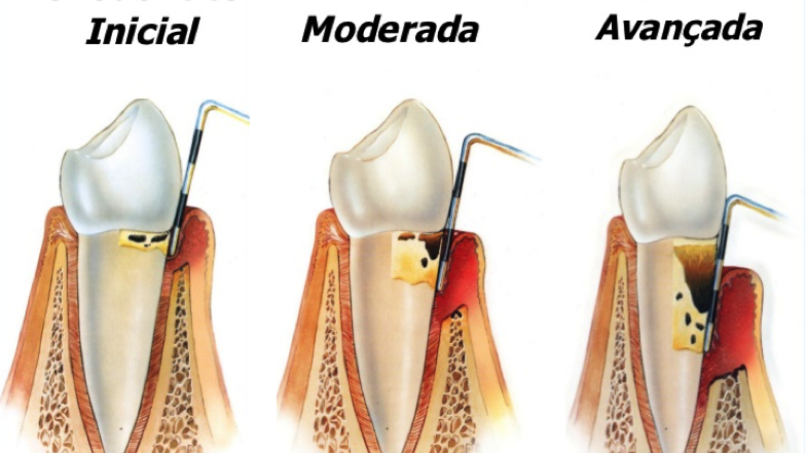 Periodontite pode levar à perda do dente