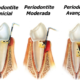 Periodontite pode levar à perda do dente