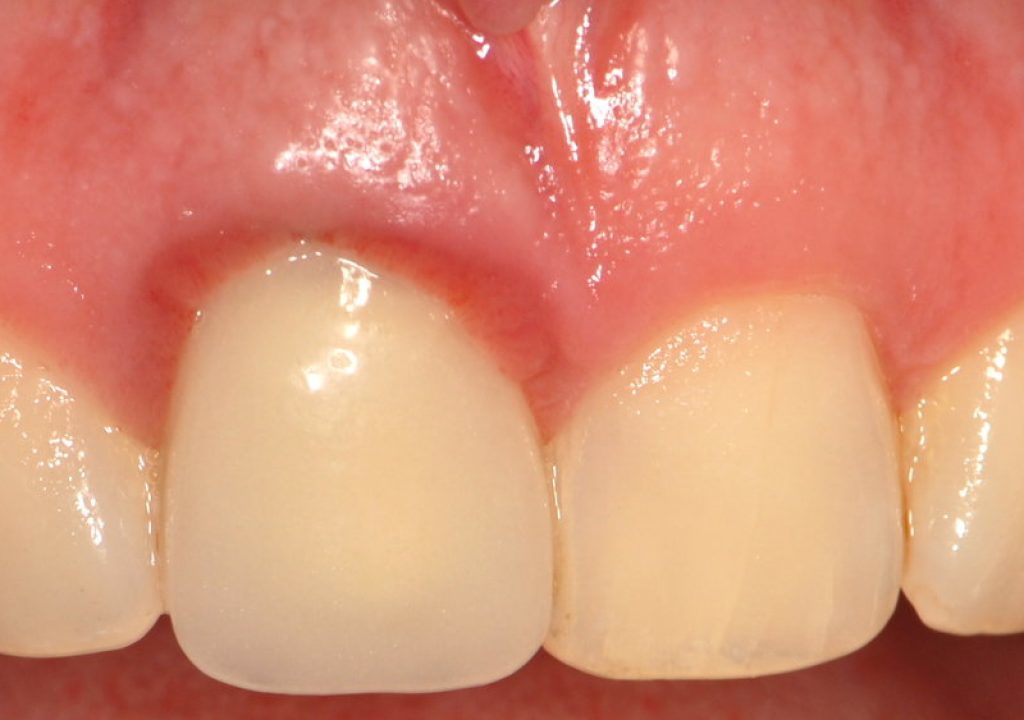 Periodontite pode levar à perda do dente? 