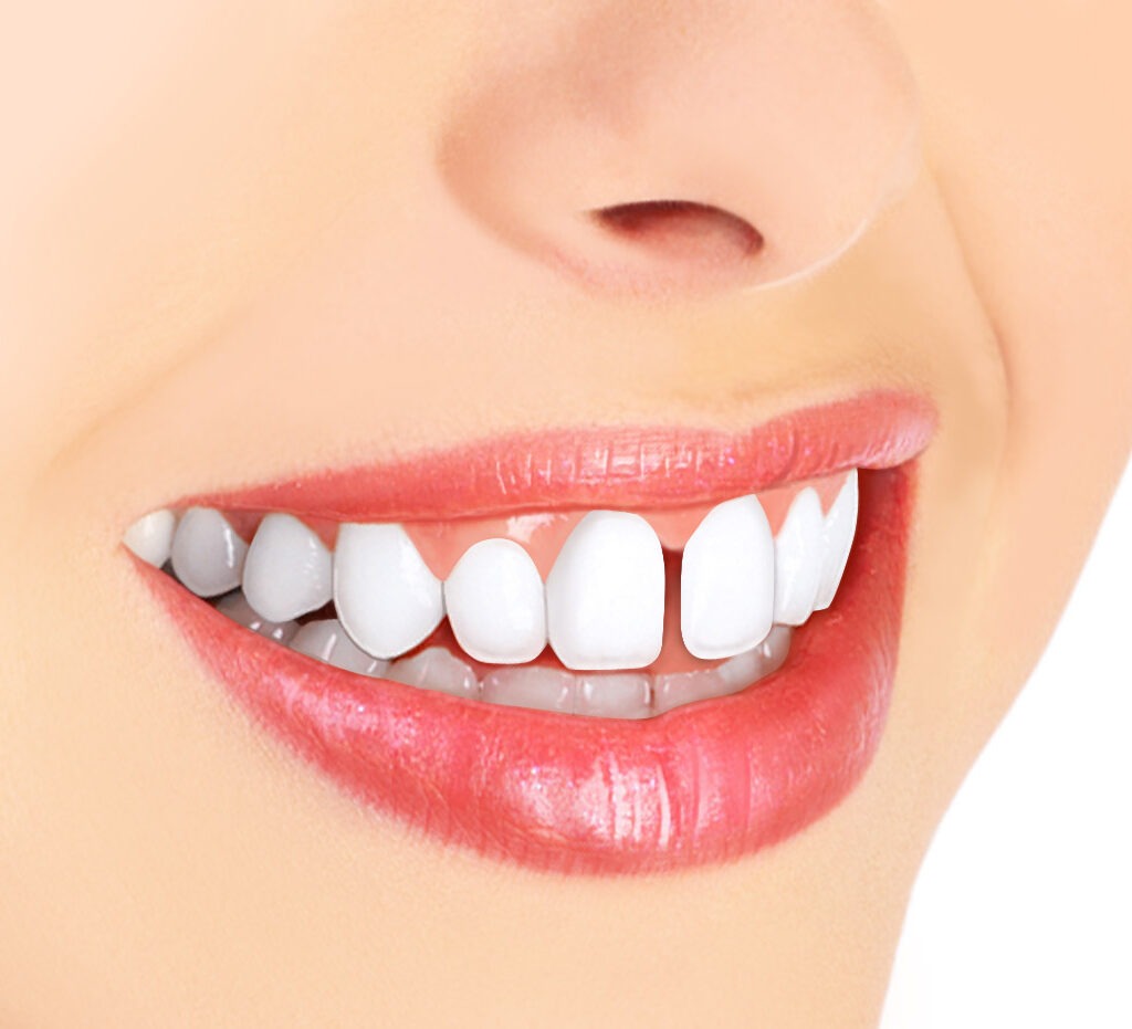 Diastema como tratar o espaço entre os dentes