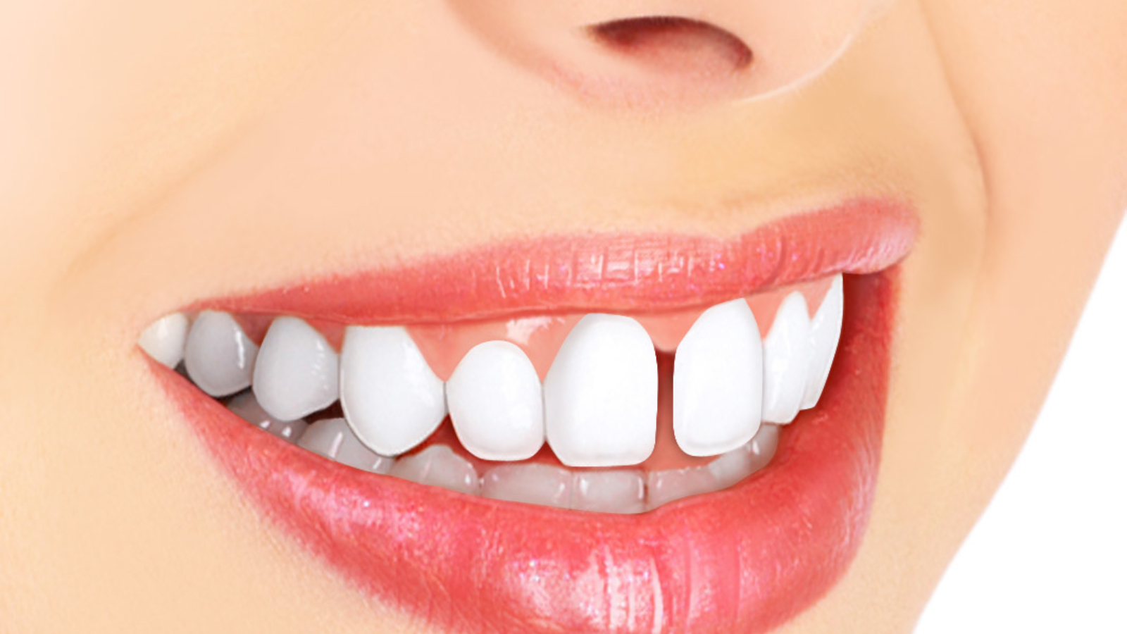 Diastema como tratar o espaço entre os dentes (2)