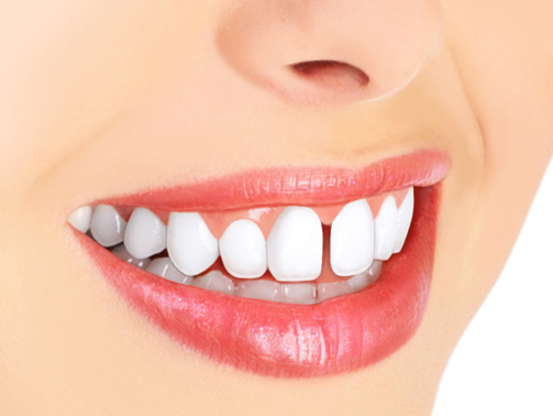 Diastema como tratar o espaço entre os dentes (2)