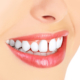 Diastema como tratar o espaço entre os dentes (2)