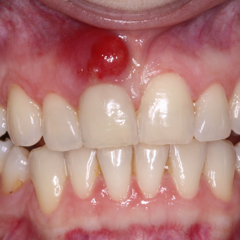 Abscesso dentário