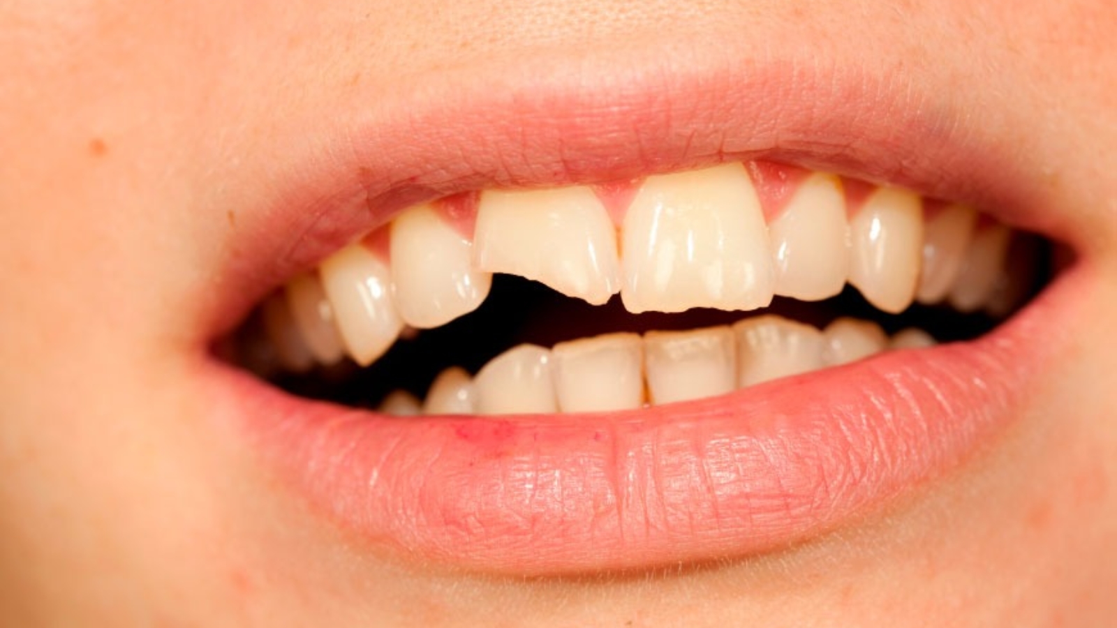 Dentes fracos e quebradiços (2)