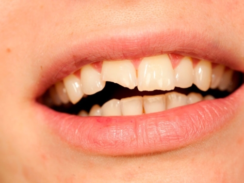 Dentes fracos e quebradiços (2)