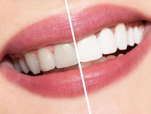 Clareamento dental ou lente de contato dental (6)