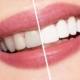 Clareamento dental ou lente de contato dental (6)
