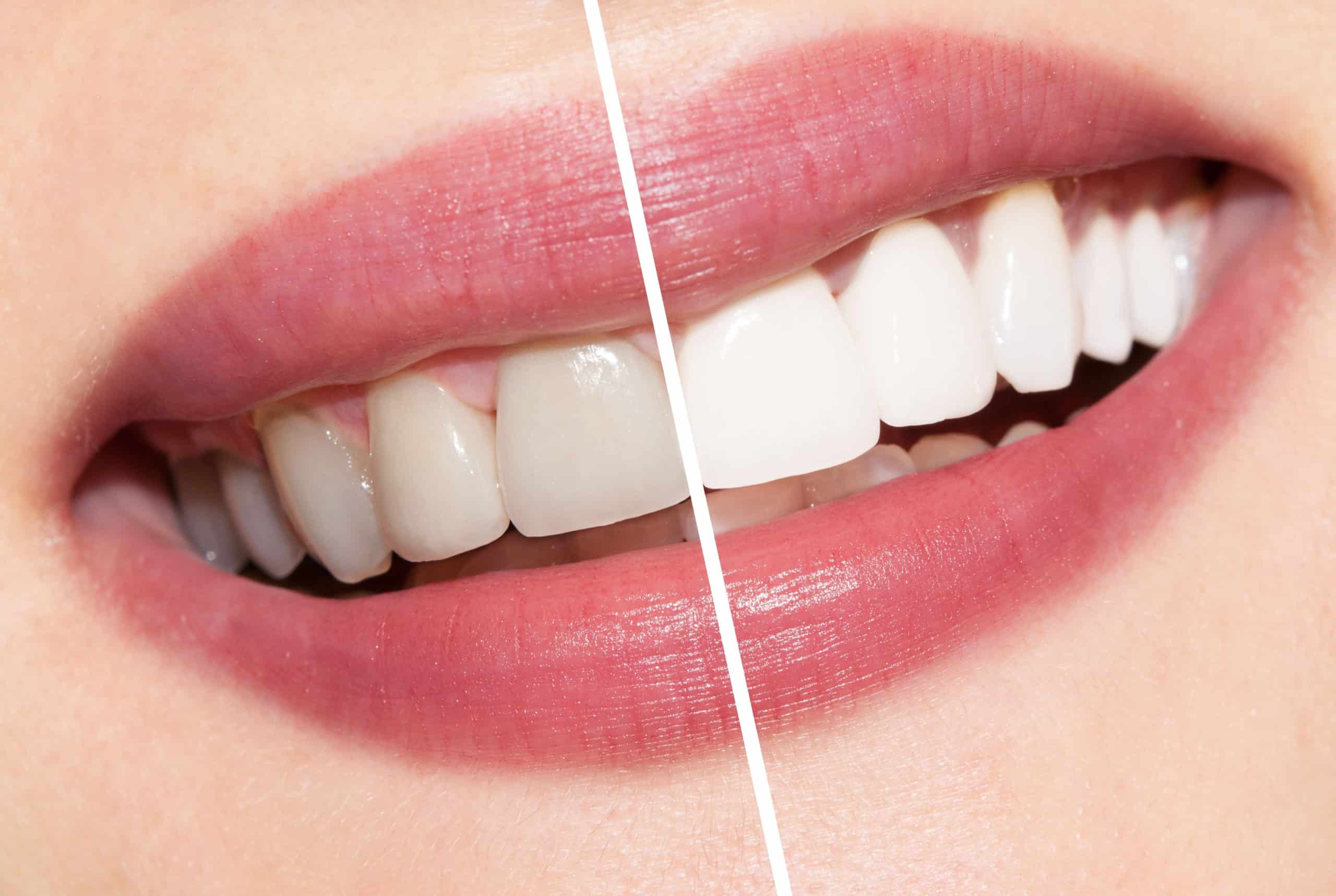 Clareamento dental ou lente de contato dental? Qual é a melhor opção?