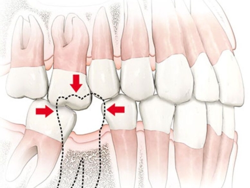 Ausência de dentes e suas consequências (3)