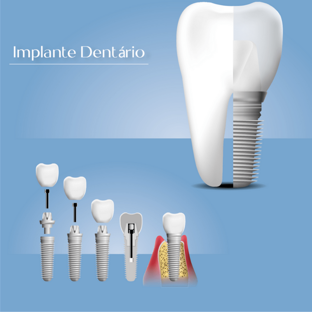 Qual a importância da manutenção do implante dentário?