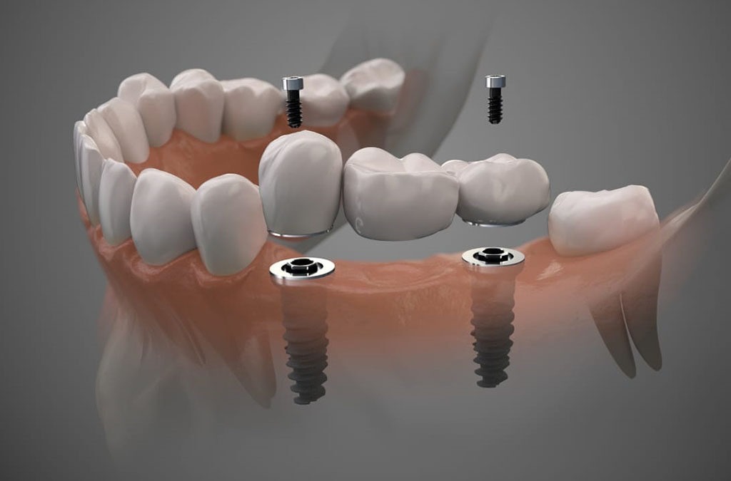 Qual a importância da manutenção do implante dentário?