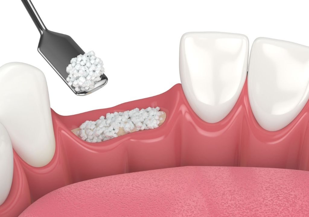 Ausência de dentes e suas consequências a curto e longo prazo.