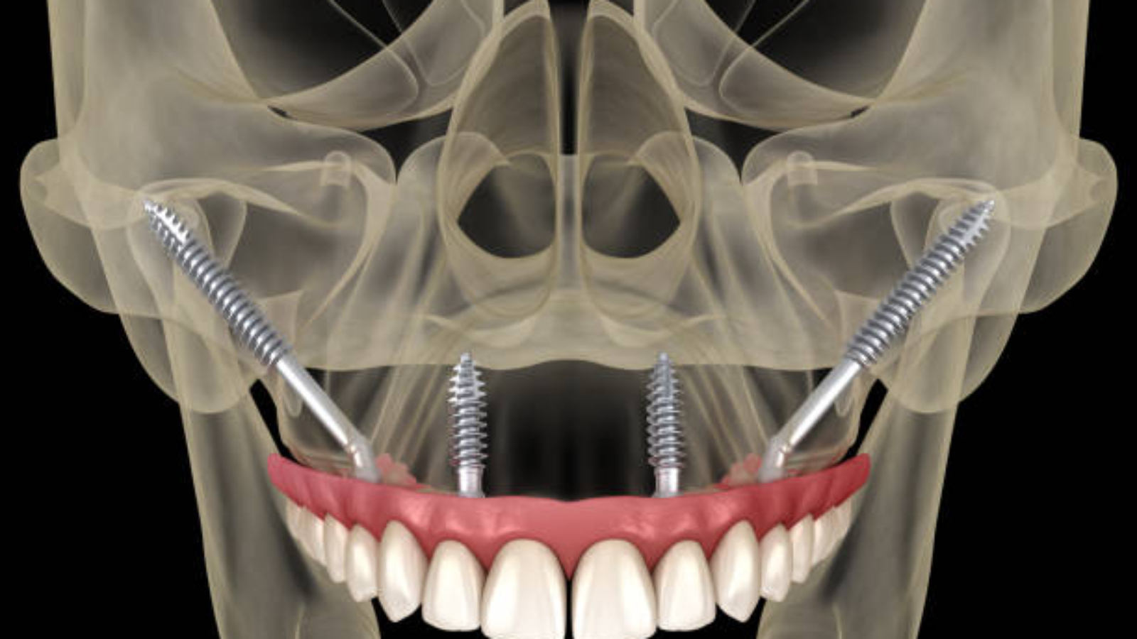 Implantes Dentários em Pacientes com Osteoporose (3)