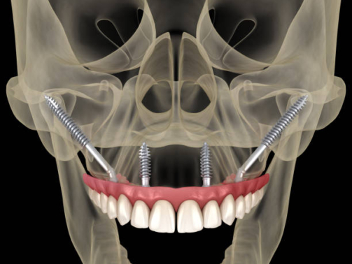 Implantes Dentários em Pacientes com Osteoporose (3)