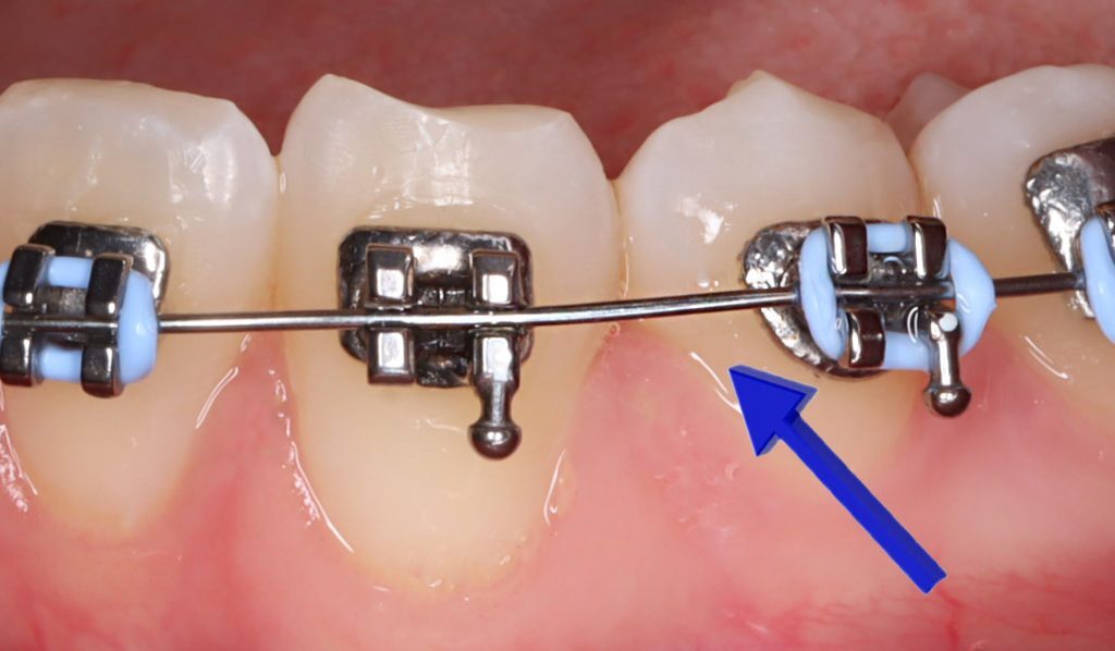 Tratamento Ortodôntico Descomplicado: Conheça as 6 Etapas Essenciais 