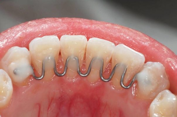 Tratamento Ortodôntico Descomplicado: Conheça as 6 Etapas Essenciais 