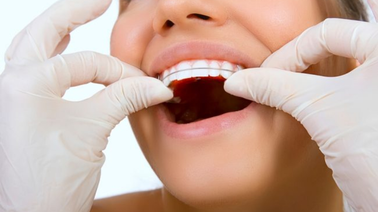 Contenção Ortodôntica (1)