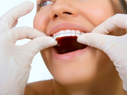 Contenção Ortodôntica (1)