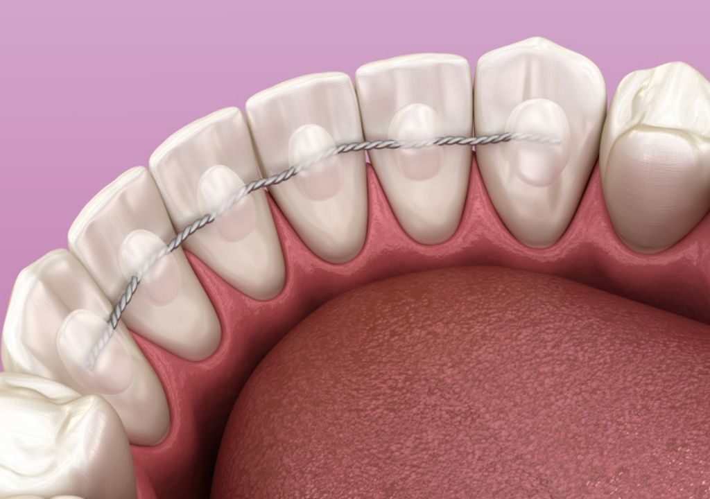 Contenção Ortodôntica: O Que Você Precisa Saber Após Tirar o Aparelho