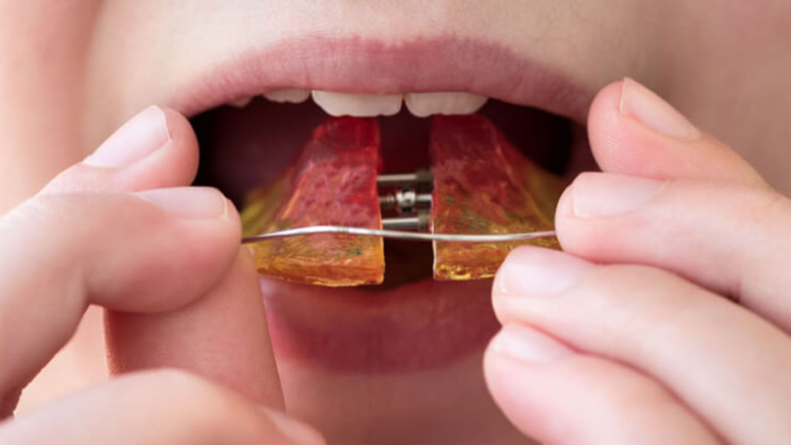 Recidiva Ortodôntica (2)