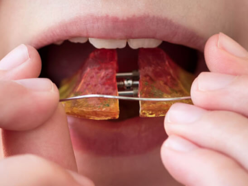 Recidiva Ortodôntica (2)