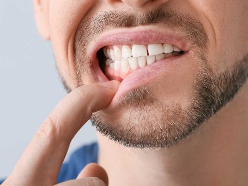 Gengivite Silenciosa (1)