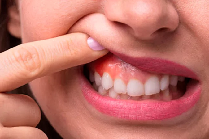 Gengivite Silenciosa: